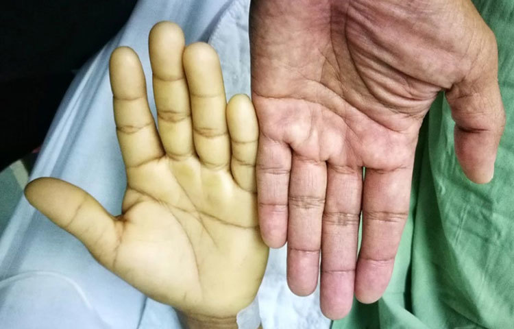 এটি অ্যানিমিয়া প্রতিরোধ করতেও সাহায্য করে।