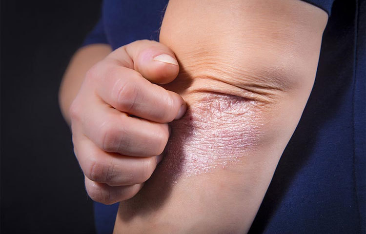 এক টেবিল চামচ বেকিং সোডার সঙ্গে এক টেবিল চামচ দুধ মিশিয়ে কনুইতে লাগান। তারপরে ভালো করে ধুয়ে নিন। একদিন পর পর তা ব্যবহার করুন।