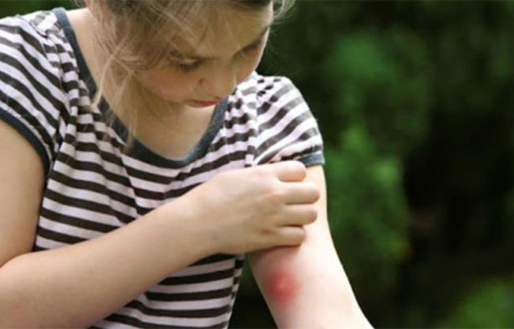 মশা কিংবা অন্য কোনও পোকা কামড়ালে অনেক সময় চুলকায় বা জ্বালা করতে থাকে। আক্রান্ত স্থানে টুথপেস্ট লাগিয়ে দিন। জ্বালাভাব বা চুলকানি কমে যাবে।