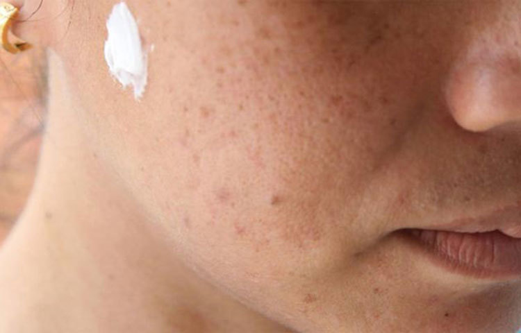 মুখে ব্রণ হলে, ব্রণের উপর টুথপেস্ট লাগিয়ে ঘুমিয়ে যান। সকালে উঠে দেখবেন ব্রণের আকৃতি ছোট হয়ে গিয়েছে। এইভাবে ধীরে ধীরে সেরেও যাবে।