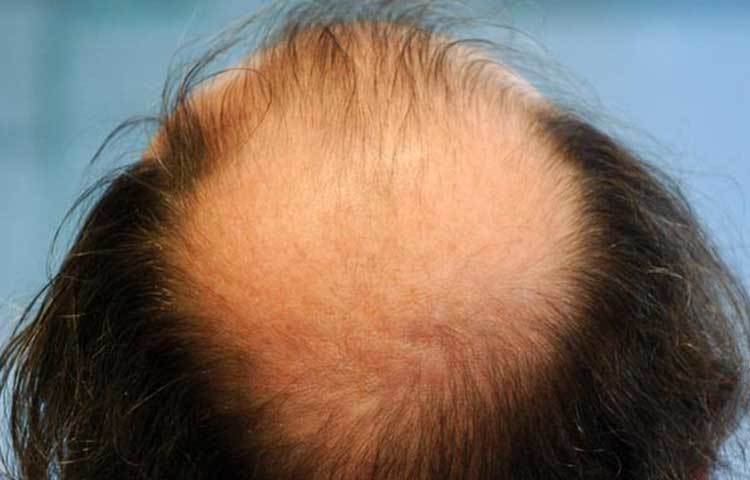 প্রয়োজনীয় মিনারেল : ডিমে রয়েছে জিঙ্ক, আয়রন, পটাশিয়াম, ক্যালসিয়াম, সেলেনিয়ামের মতো জরুরি মিনারেল, যা প্রতিটি শরীরের জন্য প্রয়োজন। এই মিনারেলের একটি কম হলেই শরীর ক্লান্ত লাগে এবং মানুষ সহজে অসুস্থ হয়ে পড়ে। তাছাড়া এসবের অভাবে শরীরে নানা ইনফেকশন, চুল পড়া বা থাইরয়েডের মতো নানা সমস্যা দেখা দেয়।