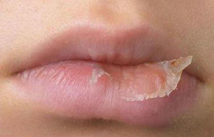 ঠোঁটের ত্বক খুবই পাতলা হওয়ায় দরুণ খুব দ্রুত তা শুষ্ক হয়ে ফেটে যায়। ঠোঁটকে ভাল রাখতে তাই প্রতিনিয়ত মরা কোষ দূর করা দরকার।