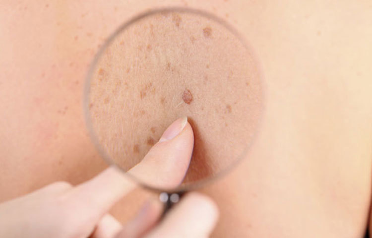 হঠাৎ ত্বকের রঙ বদল হতে শুরু করলে অবহেলা করবেন না। লিভার ক্যান্সারের এক পর্যায়ে ত্বকের রঙ হলদেটে হয়ে যেতে পারে। কখনও কখনও শ্বাসযন্ত্রে ক্যান্সারের ফলে ত্বকে নীল ছোপ দেখা দিতে পারে।