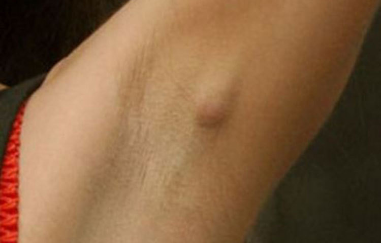 বাহুমূলে কোনও মাংসপিণ্ড বা লাম্প হলে সাবধান। বিশেষ করে মহিলারা। ব্রেস্ট ক্যান্সারের ক্ষেত্রে এটা একটা লক্ষণ হতে পারে।