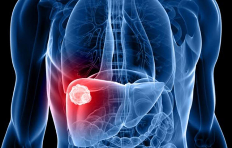 প্রাথমিক পর্যায়ে লিভার সিরোসিসে আক্রান্ত ব্যক্তির মধ্যে তেমন কোনো লক্ষণ দেখা যায় না। সমস্যা শুরু হয় যখন রোগটি মারাত্মক পর্যায়ে পৌঁছে যায়। তাই নিচের লক্ষণগুলোর কোনোটি লক্ষ্য করলে দেরি বা অবহেলা না করে চিকিৎসকের শরণাপন্ন হওয়া জরুরি।