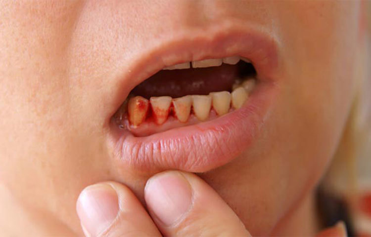 মারাত্মক পর্যায়ের লিভার সিরোসিস বা ডিকম্পেনসেটেড বা অ্যাডভান্সড সিরোসিসের লক্ষণ: (১) পায়ে-পেটে জল চলে আসা (২) জন্ডিস হওয়া এবং রোগী জ্ঞানও হারাতে পারেন (৩) রক্তবমি ও পায়খানার সঙ্গে রক্ত যাওয়া।