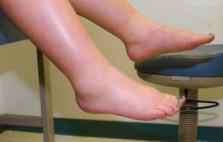 মারাত্মক পর্যায়ের লিভার সিরোসিস বা ডিকম্পেনসেটেড বা অ্যাডভান্সড সিরোসিসের লক্ষণ: (৪) ফুসফুসে জল আসা (৫) কিডনি ফেইলিউর বা কিডনির কার্যক্ষমতা হারানো (৬) শরীরের যে কোনো জায়গা থেকে অতিরিক্ত এবং নিয়ন্ত্রণবিহীন রক্তপাত ইত্যাদি।