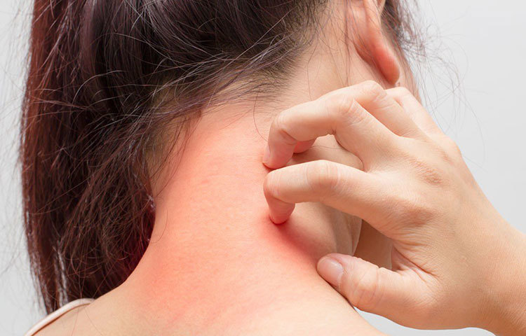 যাদের ত্বকে অ্যালার্জির প্রবণতা আছে, তারাও আম খাওয়ায় নিয়ন্ত্রণ আনুন। এদের আম খেলে চোখ জ্বালা, হাঁচি, পেটে ব্যথা, ঠান্ডা লেগে যাওয়া ইত্যাদি সমস্যা হতে পারে। তাই আম খাওয়ার আগে সচেতন থাকুন।