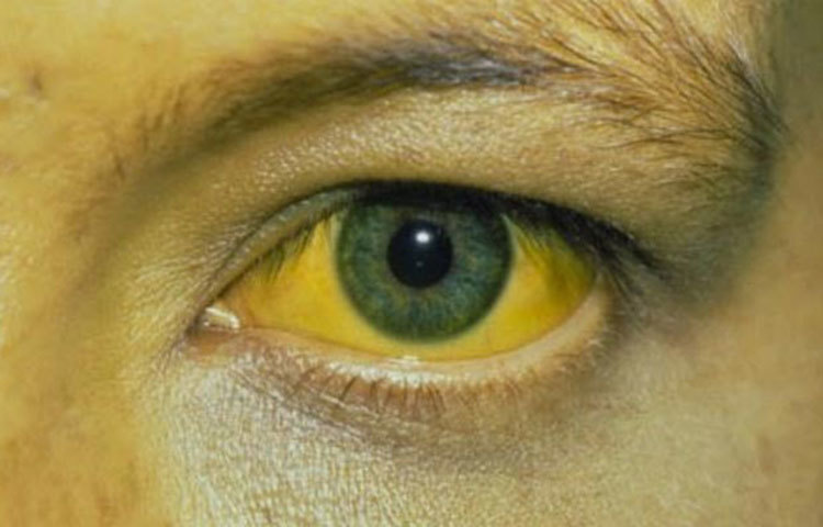 চোখ ও প্রস্রাবের রঙ হলুদ হয়ে যাওয়া ইত্যাদি।