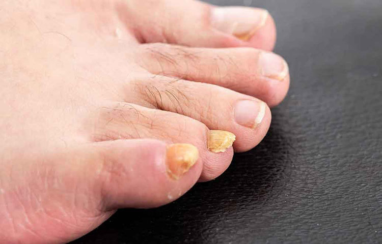 পায়ের আঙুলগুলো বয়সের সঙ্গে হলুদ হয়ে এলে তাকে স্রেফ ক্যালসিয়ামের অভাব বলে ধরবেন না। শ্বাসযন্ত্রে কোনও প্রকার সমস্যা দেখা দিলেও এমনটা হয়। তাই পায়ের নখ হলুদ হয়ে এলে দ্রুত চিকিৎসকের কাছে যান।