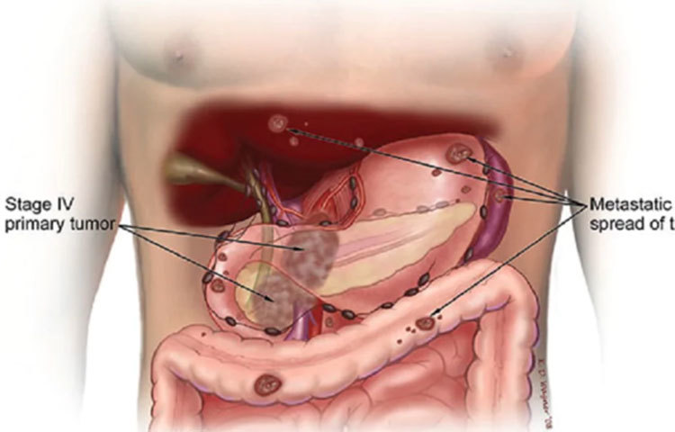 লিভার ক্যান্সার: একেবারে শেষের দিকে উপসর্গ বোঝা যায় বলে লিভার বা যকৃতের ক্যান্সার শনাক্ত করা কঠিন। লিভারের বেশিরভাগ অংশই পাঁজরের নিচে ঢাকা থাকে। যাদের মদ্যপানের অভ্যাস রয়েছে বা লিভার সিরোসিস রয়েছে, তাদের লিভার ক্যান্সারের ঝুঁকি বেশি।