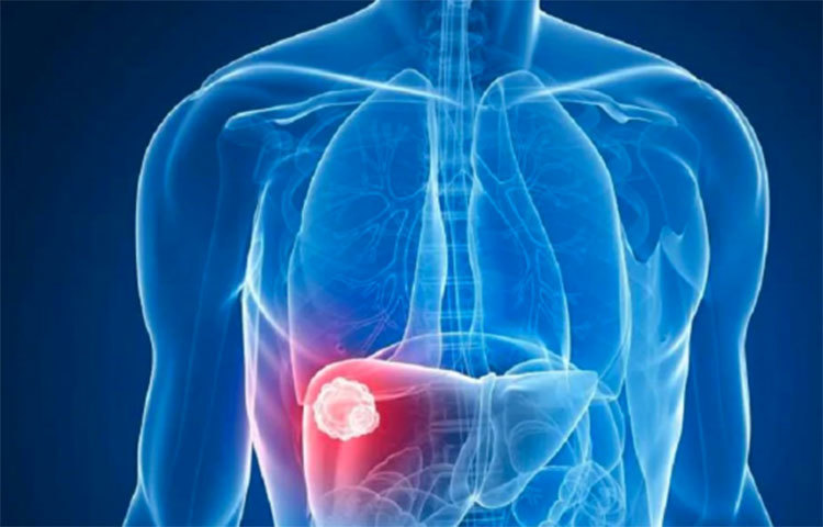 লাং ক্যান্সার: বেশির ভাগ ক্ষেত্রেই লাং বা ফুসফুসের ক্যান্সার ছড়িয়ে পড়ার পড়েই ধরা পড়ে। তেমন কোনো বিশেষ উপসর্গও থাকে না। শুধু তাই নয়, চেস্ট এক্সরেতেও ফুসফুসের ক্যান্সার ধরা পড়ে না। পিইটি বা সিটি স্ক্যানে একমাত্র ধরা পড়তে পারে।