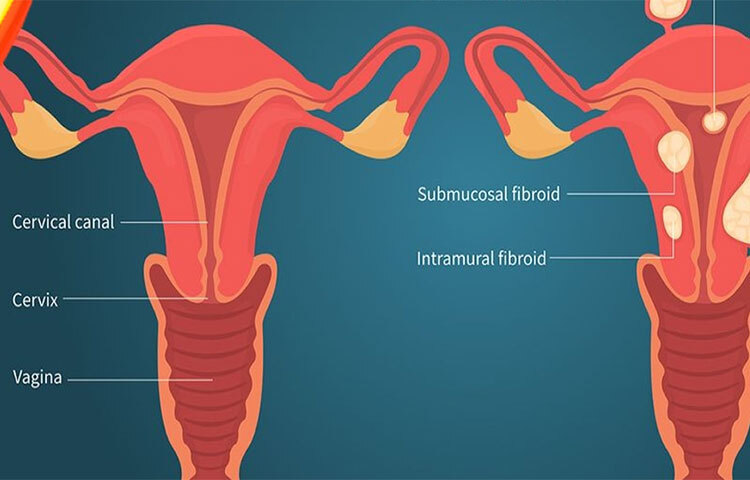 এছাড়াও হরমোনের ভারসাম্যহীনতা দেখা দেয়। ফলে মানসিক সমস্যা যেমন ডিপ্রেশন, খিটখিটে মেজাজ দেখা যায়। শরীর ও মন খারাপ থাকলে স্বাভবিকভাবেই তা আমাদের দৈনন্দিন জীবনে প্রভাব ফেলে। ফলে এই সাতটি লক্ষণ দেখা দিলে অবশ্যই ডাক্তারের সাথে পরামর্শ করুন। ছবি: সংগৃহীত