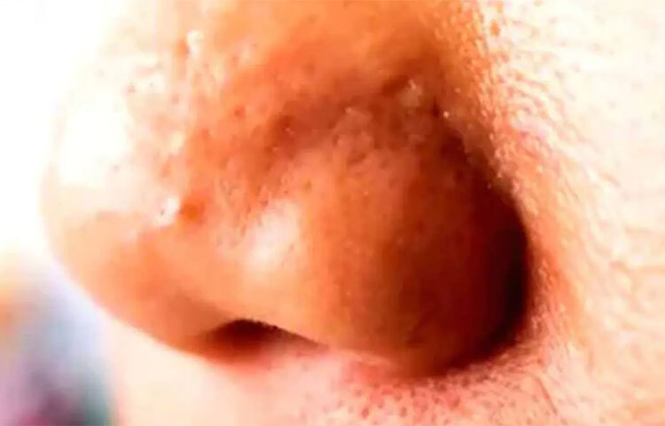 ত্বকের সুস্থতা ও সৌন্দর্যের জন্য সামান্য পরিমাণ তেলের প্রয়োজন আছে ঠিকই। কিন্তু অন্যদিকে বাড়তি তেল ত্বকের ক্ষতিও করে। এর মধ্যে অন্যতম তৈলাক্ত নাক। ফলস্বরূপ নাক জুড়ে ব্ল্যাক এবং হোয়াইটহেডস দেখা যায়। ছবি: সংগৃহীত