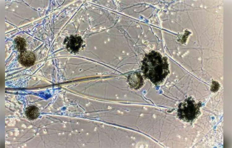 এ ছাড়াও কারো নিউমোনিয়া হয়ে থাকলে তার ক্ষেত্রে এই ছত্রাকে আক্রান্ত হওয়ার সম্ভাবনা অনেক বেড়ে যায়। তবে বিশেষজ্ঞরা বলছেন, সুস্বাস্থ্যের অধিকারী মানুষের আতঙ্কিত হওয়ার প্রয়োজন নেই। অযথা দুশ্চিন্তা করবে না। ছবি: সংগৃহীত