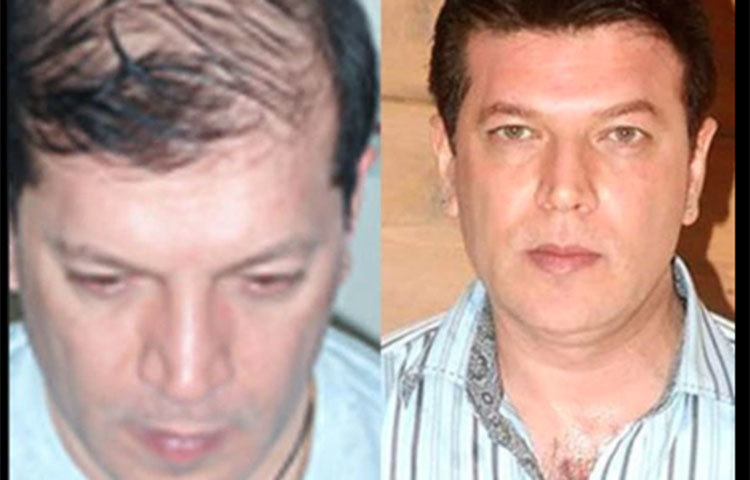 ৯ এর দশকে আদিত্য পাঞ্চোলির চুল উঠে যে টাক পড়ে যাচ্ছিল সেটা হয়তবা অনেকেই খেয়াল করে থাকবেন। ঘনিষ্ঠ সূত্রে খবর, আদিত্য নাকি এই টাক ঢাকতে হেয়ার ট্রান্সপ্লান্টের সাহায্য নেন।