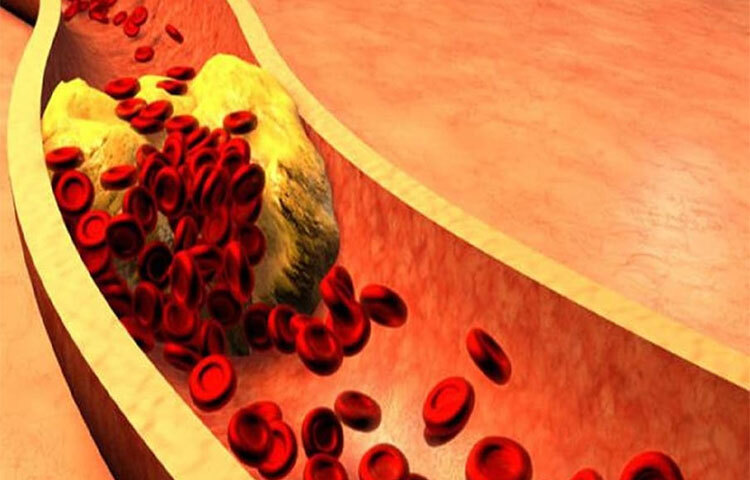 এক গবেষণা অনুযায়ী, যাদের রক্তের গ্রুপ ‘এ’, তাদের কম বয়সে স্ট্রোকের ঝুঁকি সবচেয়ে বেশি। ‘ও’ গ্রুপের রক্ত যাদের, তাদের ক্ষেত্রে এই ঝুঁকি সবচেয়ে কম। ছবি: সংগৃহীত