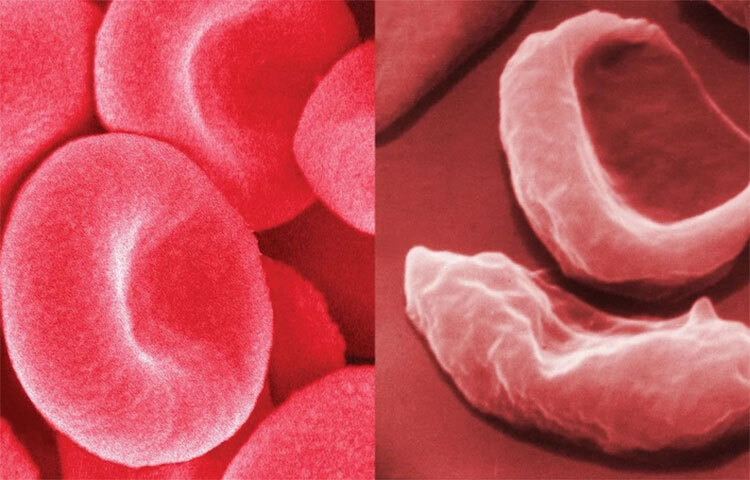 গবেষকদের মতে, যাদের রক্ত ‘এ’ গ্রুপের, তাদের অল্প বয়সে স্ট্রোকের ঝুঁকি ১৮ শতাংশ বেশি। অন্য দিকে, যাদের রক্তের গ্রুপ ‘ও’, তাদের অন্যদের তুলনায় প্রাথমিক স্ট্রোকের ঝুঁকি ১২ শতাংশ কম। ছবি: সংগৃহীত