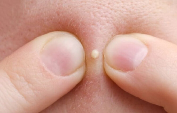 কোনো গুরুত্বপূর্ণ অনুষ্ঠানে আপনার সেজেগুজে যাওয়ার কথা! আর আপনি সকালে উঠে দেখলেন ডান গালে একটা মুসুর ডালের বড়ার মতো ব্রণ। এটি দেখেই ক্রিম, লোশন, মলম আর নানা রকম টোটকা ব্যবহার করেন অনেকে। তাতে যে একেবারেই কাজ হয় না তা নয়! তবে দুদিন পরে আবার অন্য গালে ব্রণ দেখা যায়।