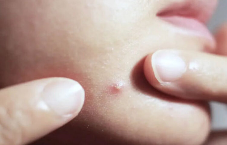 অনেক সময় কিছু সাধারণ পদ্ধতি মেনে চললে ব্রণ কমে যায়। বেশি করে পানি পান করলে, সুষম ডায়েট মানলে এবং অবশ্যই জাঙ্ক খাবার এড়িয়ে চললে ব্রণ এমনিতেই কমে যায়। তবে সেটা দ্রুত হবে না। কিছু সময় লাগবে। যদি আপনার এতো ধৈর্য না থাকে, তা হলে এই 
দ্রুত টোটকাগুলো ট্রাই করে দেখুন।