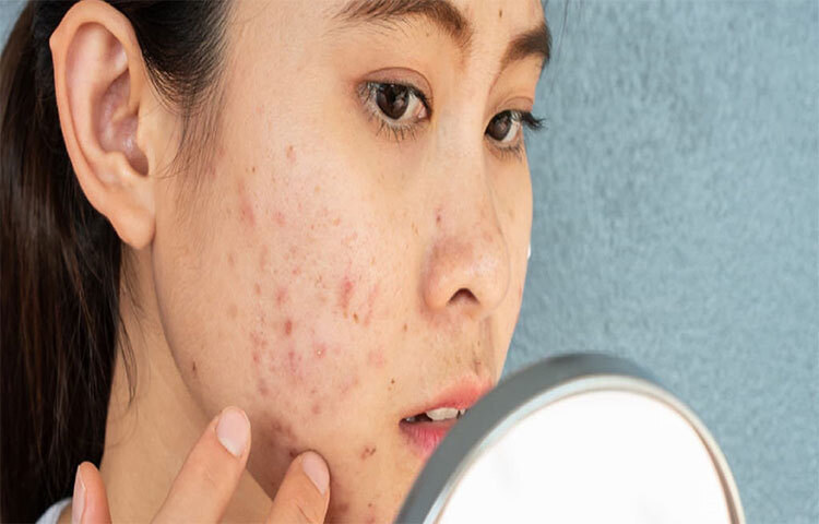 ব্রণর ধরন বুঝতে হবে:  ব্রনর ধরন সনাক্ত করতে এবং কীভাবে ব্রণ নিরাময় সম্ভব তা জানতে চর্মরোগ বিশেষজ্ঞের পরামর্শ নেওয়া উচিত। ব্লাকহেডস, পিনহেডস, হোয়াইটহেডস, প্যাপিউলস, সিস্টিক ব্রণ এবং পাস্টুলস হল কিছু সাধারণ ব্রণর প্রকার। জীবনধারা, জেনেটিক্স এবং ত্বকের প্রকারের উপর নির্ভর করে কোনও ব্যক্তি এগুলির যে কোনো একটার দ্বারা প্রভাবিত হতে পারেন। প্রতিটি প্রকারের জন্য নিরাময় ভিন্ন। মনে রাখতে হবে পিম্পলের সঠিক চিকিৎসা না করালে তা আরও বাড়তে পারে। ছবি: সংগৃহীত