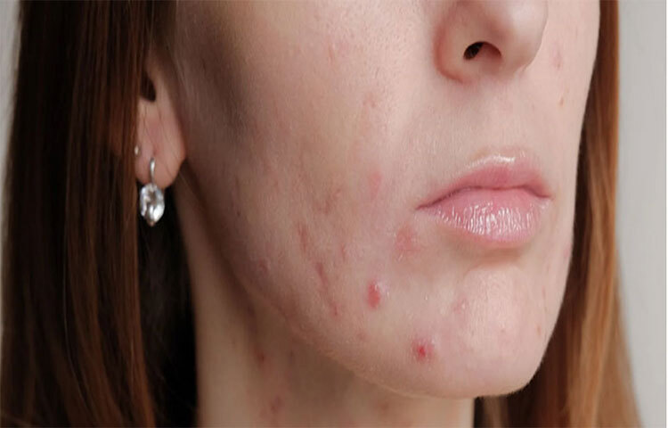 সানস্ক্রিন: রোদে শুধু ট্যানিং হয় তাই নয়, এটা ব্রনর সমস্যার অন্যতম কারণও হতে পারে। তাই রোদে বের হওয়ার অন্তত ২০ মিনিট আগে ১৫ এসপিএফ-সহ একটি সানস্ক্রিন ব্যবহারের পরামর্শ দেওয়া হয়। ত্বকের প্রকারের উপর নির্ভর করে, রোদে পোড়া, ফুসকুড়ি, জ্বালা, প্রদাহ এবং অবশ্যই ব্রণ হতে পারে। তৈলাক্ত ত্বক হলে তেলমুক্ত সানস্ক্রিন বাছাই করতে হবে। ত্বক শুষ্ক হলে, জোজোবা তেল, পাইকনোজেনল (আঙ্গুরের বীজের নির্যাস), স্যাক্সিফ্রেজ বা শসার নির্যাস দেওয়া সানস্ক্রিন ব্যবহারের পরামর্শ দেওয়া হয়। ছবি: সংগৃহীত