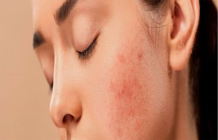 বালিশের ওয়ার বদলাতে হবে: এক্ষেত্রে বালিশের ওয়ার সবচেয়ে বড় শত্রু হতে পারে। এতে প্রতিদিন মুখ এবং চুলের ঘাম, তেল লাগে। যার ফলে একসময় ‘একনে মেকানিকা’ সৃষ্টি হয়। এটা এমন একটা অবস্থা যেখানে মুখ স্পর্শ করা বস্তু বা উপাদানের কারণে ব্রণর প্রাদুর্ভাব ঘটে। ছবি: সংগৃহীত