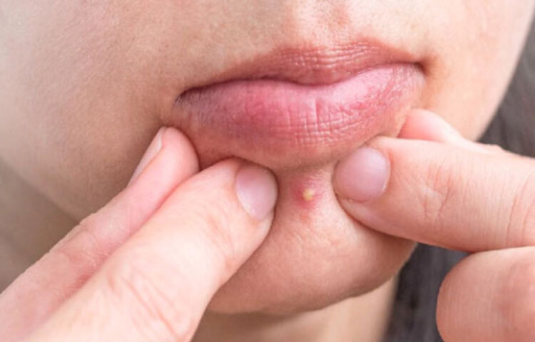 অ্যাস্পিরিন ট্যাবলেট আছে বাড়িতে? হ্যাঁ, যেটা মাথা ধরার কাজ দেয়। ওই ট্যাবলেট গুঁড়ো করে পেস্ট বানিয়ে ব্রণে লাগান। এর অ্যান্টি-ইনফ্লেমেটরি গুণ আপনার ব্র্রণ সারিয়ে দেবে।