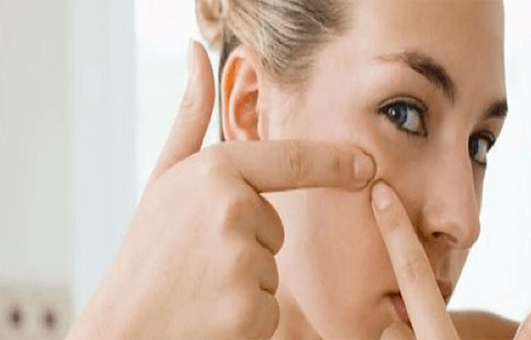 ব্রণ খোঁটা বন্ধ করতে হবে: ব্রণ খোঁটার জন্য অনেকেরই নিশপিশ করে। এতে ভালো তো কিছু হয় না উল্টে ক্ষতি করে। ব্রণ খুঁটে তুলে ফেললে সেই জায়গার ত্বক ছিঁড়ে যায়। সঙ্গে সেই জায়গা থেকে ব্যাকটেরিয়া ত্বকের অন্য ছিদ্রে ছড়িয়ে পড়ে। ফলে আরও বেশি ব্রন হওয়ার সম্ভাবনা থাকে। ছবি: সংগৃহীত