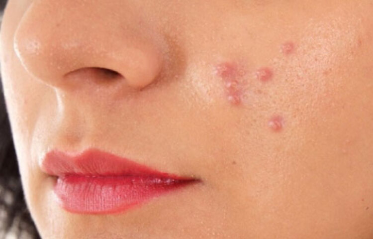 ব্রণ সহজে যেতে চায় না। যায় আর আসে। তাই আপনাকে বাড়তি সতর্ক থাকতে প্রতিদিনের স্কিন কেয়ার রুটিন মেনে চলতে হবে। চেষ্টা করবেন বেশি রাসায়নিকযুক্ত কোনো বিউটি প্রোডাক্ট ব্যবহার না করতে।