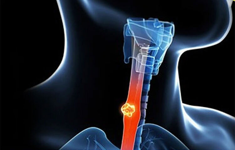 আমেরিকার জাতীয় ক্যানসার ইনস্টিটিউটের গবেষক, সারা এস জ্যাকসন এবং তার সহকর্মীরা, ৫০-৭১ বছর বয়সী ১৭১,২৭৪ জন পুরুষ এবং ১২২,৮২৬ জন নারীকে এই বিষয়ক গবেষণার জন্য বেছে নেন। তারা মোট ২১ ধরনের ক্যানসারে আক্রান্ত ছিলেন। তারা এই ২১ ধরনের ক্যানসার কতটা ঝুঁকিপূর্ণ তা খতিয়ে দেখেন। ছবি: সংগৃহীত