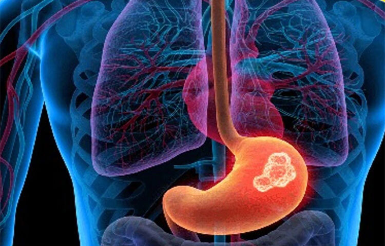 গবেষণা থেকে দেখা যায় একমাত্র থাইরয়েড এবং গলবøাডারের ক্যানসারের ক্ষেত্রেই নারীদের ঝুঁকি পুরুষদের থেকে বেশি। বাকি সবক্ষেত্রেই পুরুষদের ঝুঁকি বেশি (১.৩-থেকে ১০.৮ গুণ)। পুরুষদের মধ্যে খাদ্যনালীর ক্যানসার (১০.৮-গুণ বেশি ঝুঁকি), স্বরযন্ত্র (৩.৫-গুণ বেশি ঝুঁকি), গ্যাস্ট্রিক কার্ডিয়া (৩.৫-গুণ বেশি ঝুঁকি) এবং মূত্রাশয়ের ক্যানসারের (৩.৩-গুণ বেশি ঝুঁকি) সম্ভাবনা অনেক বেশি লক্ষ্য করা হয়েছে। ছবি: সংগৃহীত