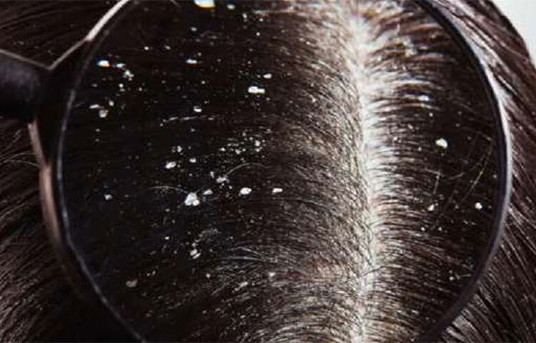 দইয়ের মধ্যে জ্বালা উপশমকারী উপাদান আছে। এ কারণেই খুশকি কমাতে দই ভীষণই কার্যকরী। ছবি: সংগৃহীত