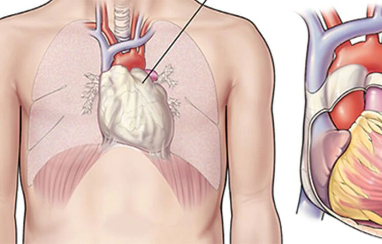 ‘পেরিকার্ডাইটিস’ হলো এই জাতীয় আর এক ধরনের সমস্যা। আমাদের বুকে কতগুলো ‘স্যাক’ বা থলি থাকে। এই থলিগুলোতে সংক্রমণ হলে এখানেও প্রদাহ অনুভূত হয়। আর তা থেকে বুকে ব্যথা হয়। ছবি: সংগৃহীত