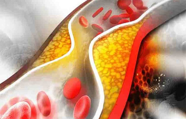 কোলেস্টেরলের স্তর নিয়ন্ত্রিত থাকলে বিশেষভাবে সুবিধা পাওয়া যাবে। ছবি: সংগৃহীত