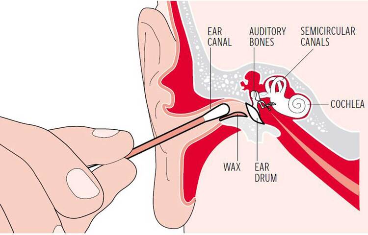 অধিকাংশ লোকের ধারণা, বাড়িতেই নিয়মিত কান পরিষ্কার করা উচিত। কটন বাডই কান পরিষ্কারের সবচেয়ে নিরাপদ, নির্ভরযোগ্য উপায়। তবে গবেষণা বলছে, এতে উপকারের চেয়ে ক্ষতিই বেশি হয়। কানের সমস্যা নিয়ে ডাক্তারদের কাছে যে লম্বা লাইন পড়ে তার মধ্যে অনেকেরই সমস্যার কারণ কটন বাড ব্যবহার।