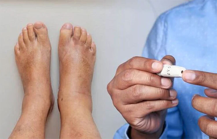 পা ফোলা: ডায়াবেটিসের তৃতীয় লক্ষণটি হল পা ফোলা। আপনারও যদি পায়ে ফোলাভাব থাকে, তাহলে এটাকে হালকাভাবে নেবেন না, কারণ এটি ডায়াবেটিসের লক্ষণ হতে পারে। পায়ে ফোলাভাব দেখা দিলে দ্রুত চিকিৎসকের পরামর্শ নিতে হবে। ছবি: সংগৃহীত