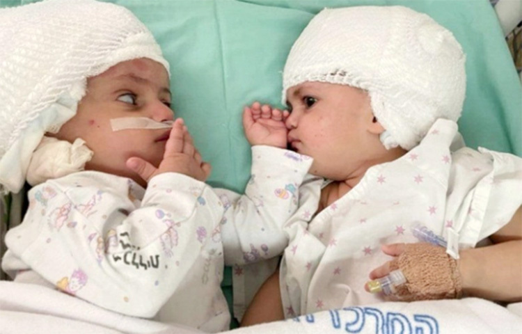 ইসরায়েলের এক বছর বয়সী দুই যমজ শিশুর জোড়া মাথা অপারেশনের মাধ্যমে আলাদা করা হয়েছে। বাচ্চা দুটি সুস্থ আছে বলে জানা গেছে। জন্মের পর প্রথমবারের মতো তারা একে অপরকে দেখতে পাচ্ছে। ছবি: সংগৃহীত