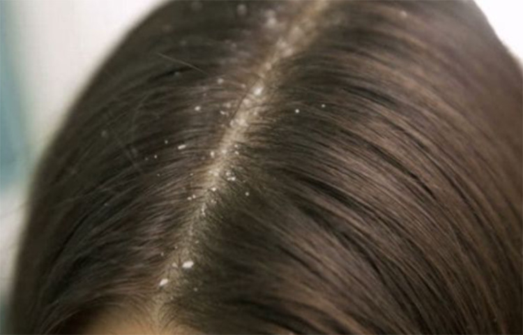 লেবুর সাইট্রিক অ্যাসিড মাথার পিএইচ-এর ভারসাম্য রক্ষা করে। মাথার অতিরিক্ত তেল বের করে দিতেও এটি খুবই কার্যকর। মাথায় পাতিলেবুর রস লাগিয়ে কিছুক্ষণ রেখে দিন। এরপর সেই রস মেশানো পানি দিয়েই ধুয়ে পেলুন তা। এরপর খুশকি প্রতিহত করতে পারে এমন কোনো শ্যাম্পু দিয়ে চুল ধুয়ে ফেলুন। ছবি: সংগৃহীত