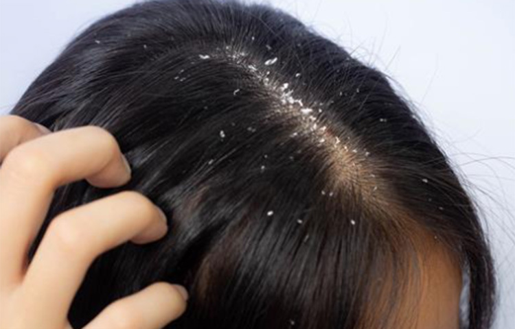 প্রতিদিন রাতে নারিকেল তেল ও ক্যাস্টর অয়েল গরম করে মিশিয়ে নিন। আঙুলের ডগায় তেল নিয়ে তা ভালো করে মাসাজ করুন চুলে। এরপর চুল বেঁধে শুয়ে পড়ুন। পরের দিন সকালে শ্যাম্পু করে নিন। সপ্তাহে তিন দিন এমন করলেই খুশকি কমবে। ছবি: সংগৃহীত