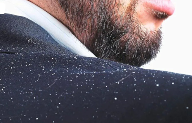 শুষ্ক আবহাওয়ায় তেল মাথায় আর্দ্রতা জোগায়। চুলের গোড়ায় পুষ্টির জোগান দেয়। এই নারিকেল তেলকে একটু গরম করে তাতেই যোগ করুন কয়েক ফোঁটা লেবুর রস। স্নানের আধ ঘণ্টা আগে এই মিশ্রণ চুলে লাগিয়ে ভালো করে মালিশ করুন। মিনিট ২০-৩০ বাদে শ্যাম্পু করে নিন। ছবি: সংগৃহীত