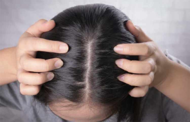 আপনি চাইলে শ্যাম্পু করার পর এক চামচ ভিনিগার নিয়ে পানিতে ভালো করে মিশিয়ে ধুয়ে ফেলুন আপনার চুল। তাতেও খুশকি দূর হয়ে যাবে। মনে রাখবেন, ভিনিগার এক চামচের বেশি যেন না পড়ে পানিতে। ছবি: সংগৃহীত