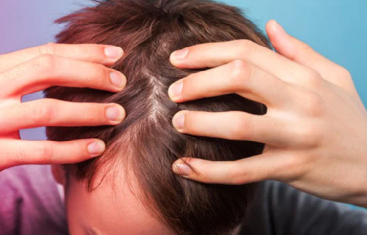 লেবুর খোসা দিয়ে দূর করতে পারেন খুশকির সমস্যা। ৪ থেকে ৫ কাপ পানিতে ৪ থেকে ৫ টি লেবুর খোসা ছাড়িয়ে নিয়ে ২০ মিনিট ধরে ফোটান। ঠান্ডা হলে মাথার ত্বকে এই মিশ্রণটি ভালো করে লাগিয়ে নিন। ৩০ মিনিট পর শ্যাম্পু দিয়ে চুল ধুয়ে নিন। ছবি: সংগৃহীত