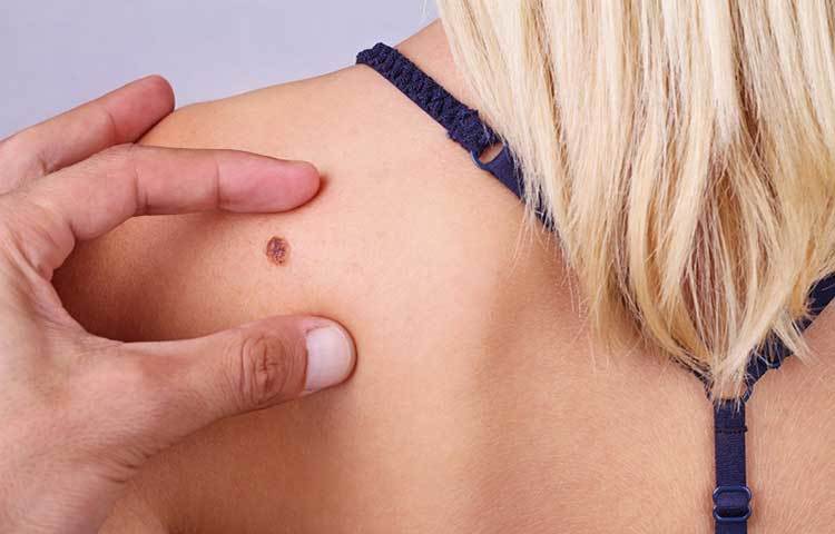 তিল ও আঁচিল: শরীরে হঠাৎ কোনো দাগ দেখতে পেলে সাবধান। শরীরে হঠাৎ করে তিল বা আঁচিলের সংখ্যা বেড়ে গেলেও নজরদারি দরকার। তিল বা আঁচিল ক্ষতিকর নয়। কিন্তু তিল বা আঁচিলের বদল থেকে বড় সমস্যা হতে পারে।