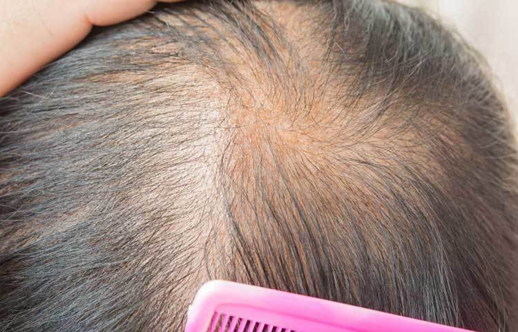 চুল পাতলা হয়ে যাওয়া: নারীদের ক্ষেত্রে চুলের ঘনত্ব কমে যাওয়াটা ভয়ংকর। যদি খুব বেশি চুল পড়ে যেতে থাকে তাহলে চিকিৎসকের কাছে যাওয়া দরকার। পুষ্টিহীনতা বা কোনো অসুখ থেকে এমনটা হতে পারে।