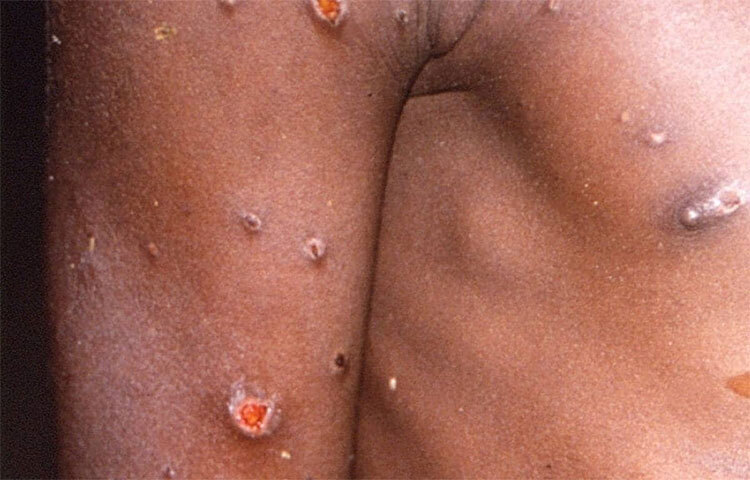 চিকেন পক্সে আক্রান্ত হওয়ার সম্ভাবনাও মারাত্মক থাকে বলে বিশেষজ্ঞরা জানিয়েছেন। এখন আবার বিশ্বজুড়ে মাঙ্কিপক্সের আতঙ্কও ছড়িয়েছে। ছবি: সংগৃহীত