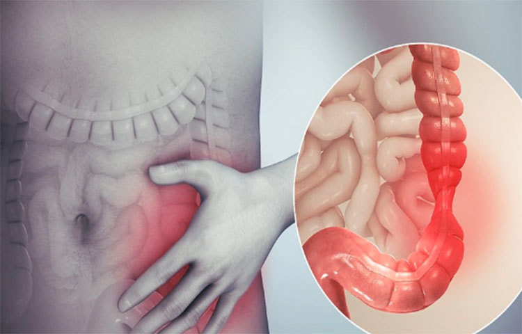 চিকিৎসকরা বলছেন, মলের রঙ যদি কালো বা গাঢ় বাদামি হয়, তা হলে রীতিমতো উদ্বেগের। সে ক্ষেত্রে তা ক্যান্সার বাসা বাঁধারই লক্ষণ। কোলন ক্যান্সার হলে খাওয়ার সময় তলপেটে ব্যথা হয়।
