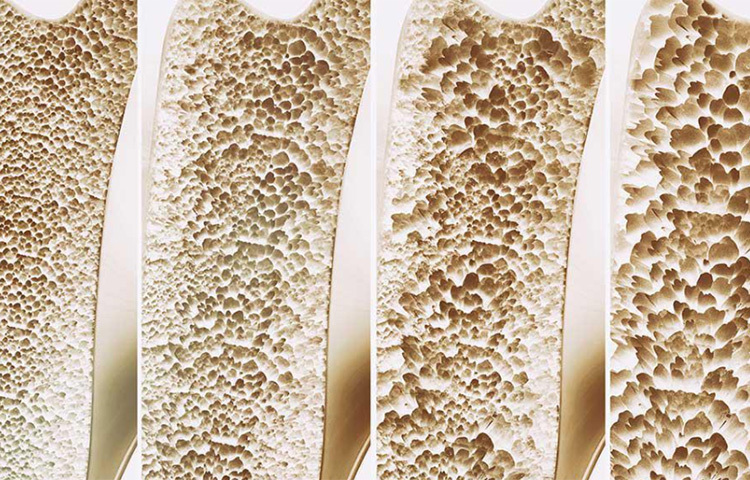 অস্টিওপোরোসিস: অস্টিওপোরোসিস একটি হাড়ের রোগ। এটির কোনো লক্ষণ বা উপসর্গ দেখা যায় না, যতক্ষণ না কোনো ফ্র্যাকচারের মধ্য দিয়ে ধরা না যাচ্ছে। তাই ক্যালসিয়াম এবং ভিটামিন উ সমৃদ্ধ খাবার খাওয়া নিয়মিত রুটিনে রাখা খুব প্রয়োজন। নিয়মিত চেক আপ করাও প্রয়োজন। ছবি: সংগৃহীত