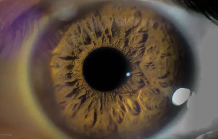 ছানি হলো চোখের এক ধরনের রোগ। এ রোগ দেখা দিলে প্রাথমিকভাবে চোখের লেন্স অস্বচ্ছ বা ঘোলা হতে শুরু করে, ফলে দৃষ্টিশক্তি ক্ষীণ হতে থাকে। ছবি: সংগৃহীত