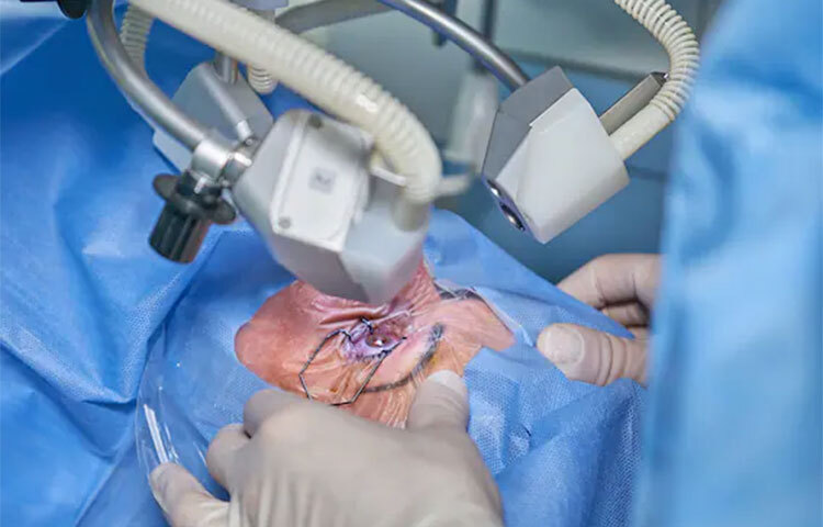 তবে ছানির সমস্যা এড়ানোর জন্য চোখের যত্ন নেওয়া খুব প্রয়োজন। দীর্ঘদিন ডায়াবেটিস বা অন্য কোনো রোগ থাকলে চোখের ডাক্তারের কাছ থেকে নিয়মিত চোখ পরীক্ষা করানো খুব প্রয়োজনীয়। ছবি: সংগৃহীত